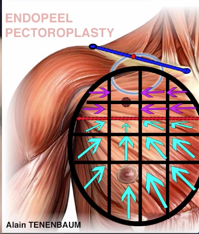 male-pectoroplasty-marking