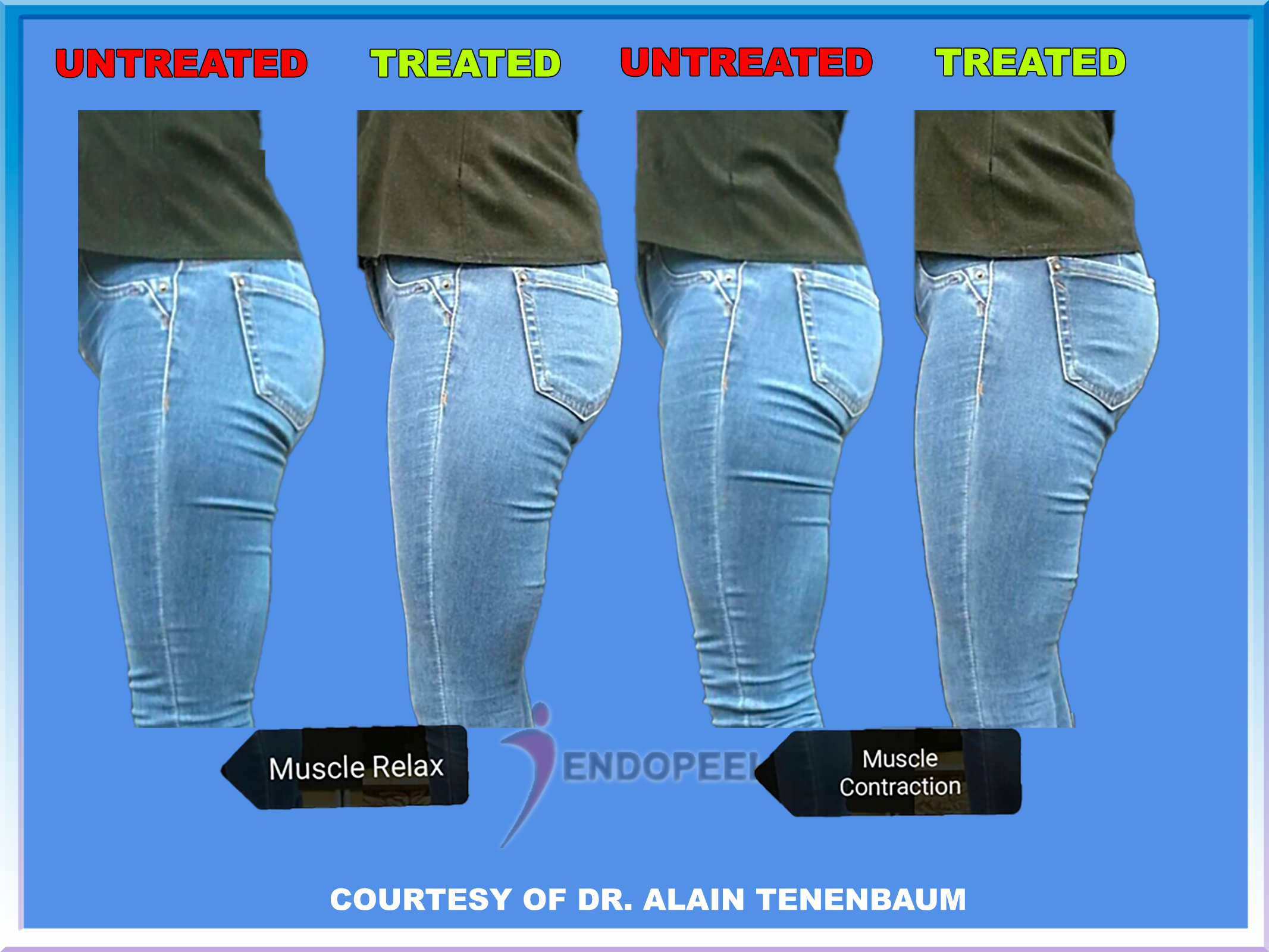 gluteo fem 05
