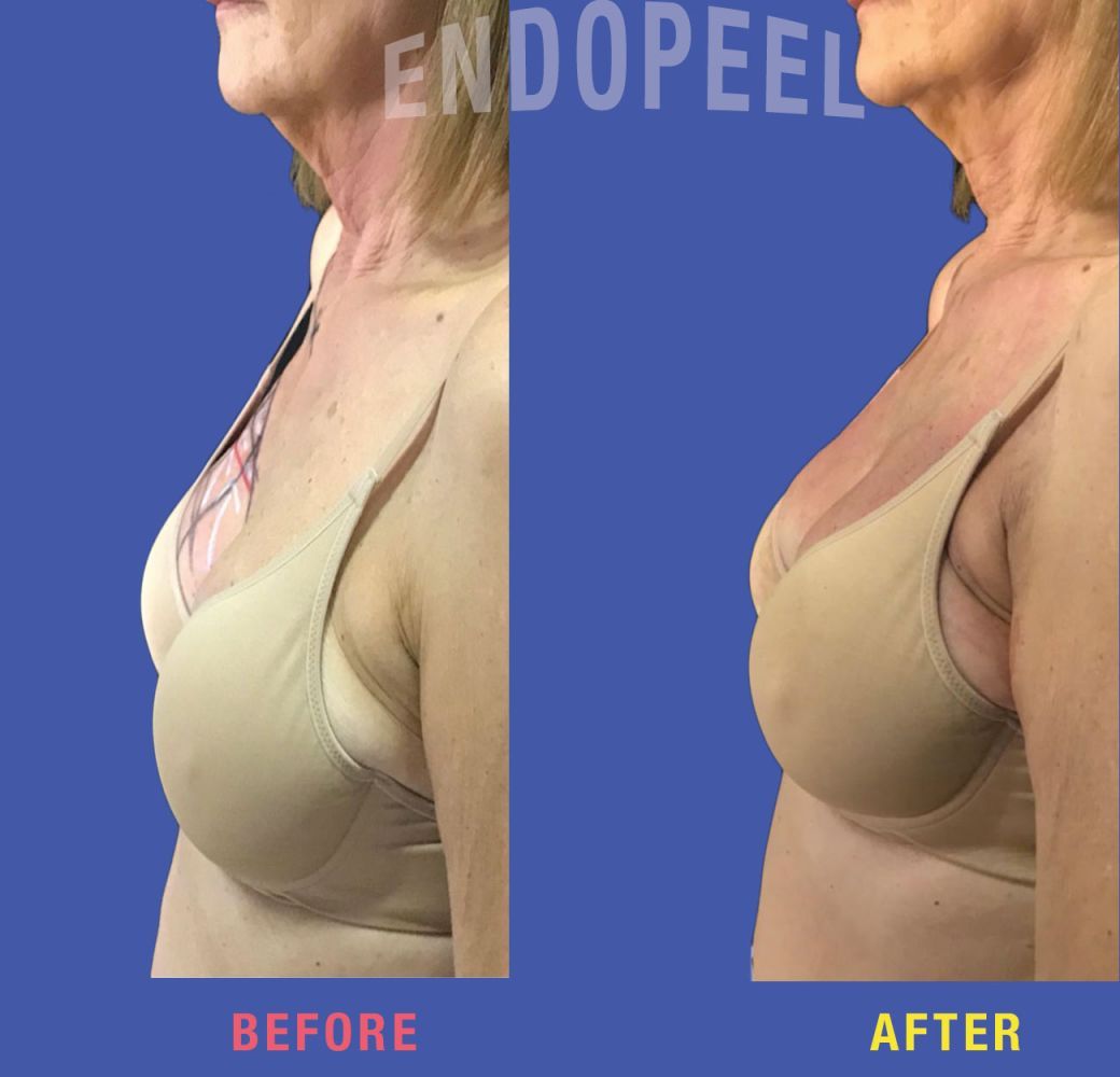 female pectoroplasty endopeel