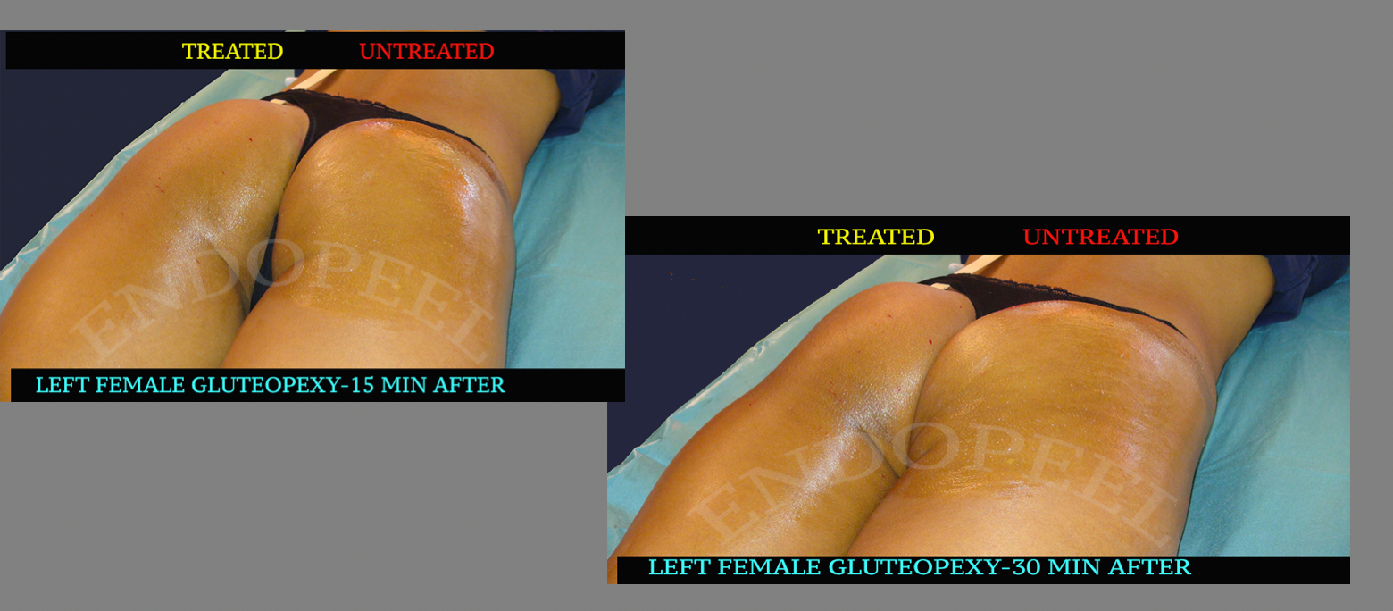 endopeel female gluteoplasty