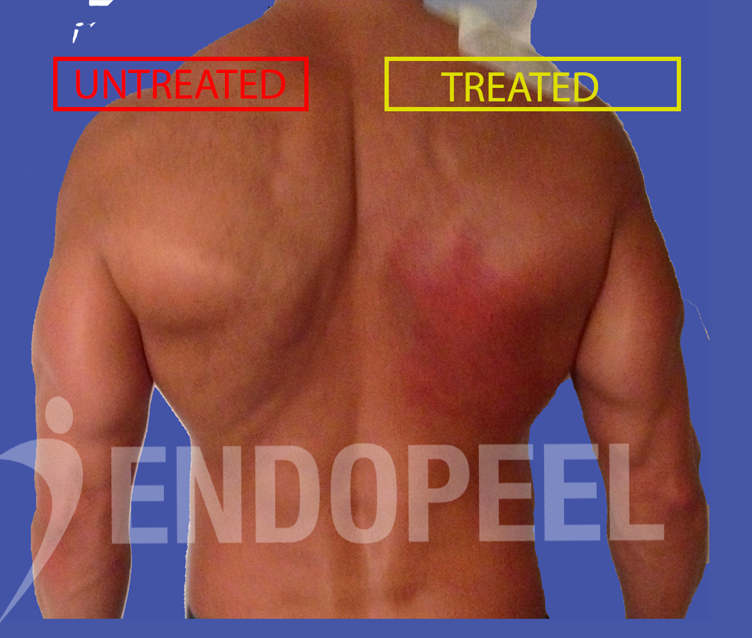 trapezes and shoulders