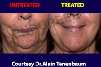 face-endopeel