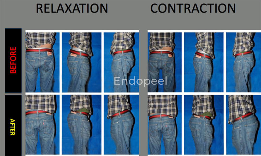 male gluteoplasty