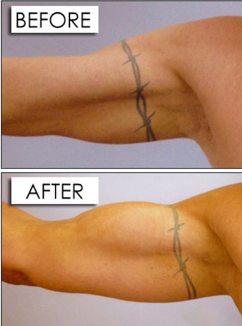 biceps projection